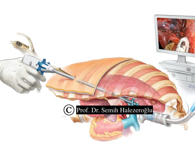 Tek Port VATS operasyonu
